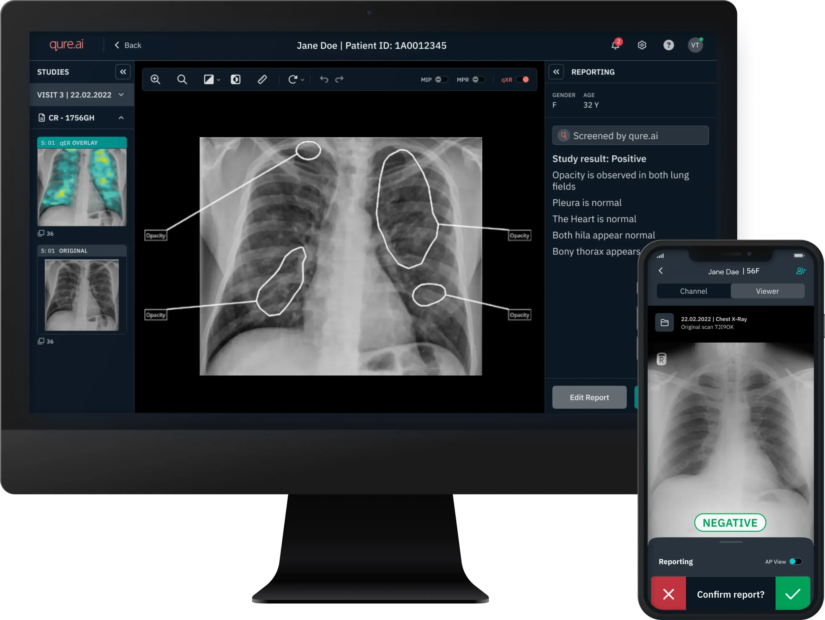Chest X-ray reporting.webp