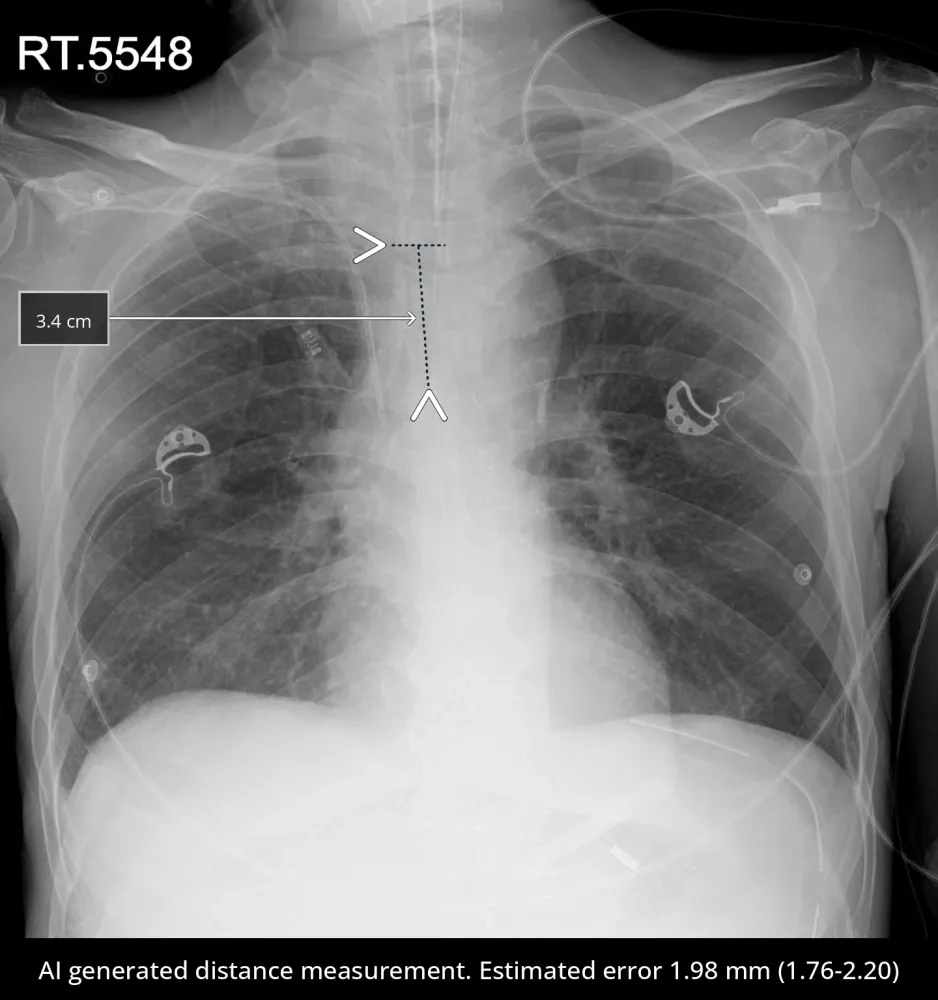 qXR AI enabled comprehensive Chest X-ray reporting tool