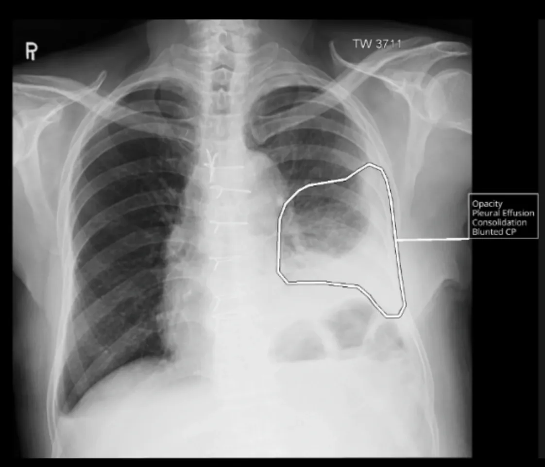 qXR AI enabled comprehensive Chest X-ray reporting tool