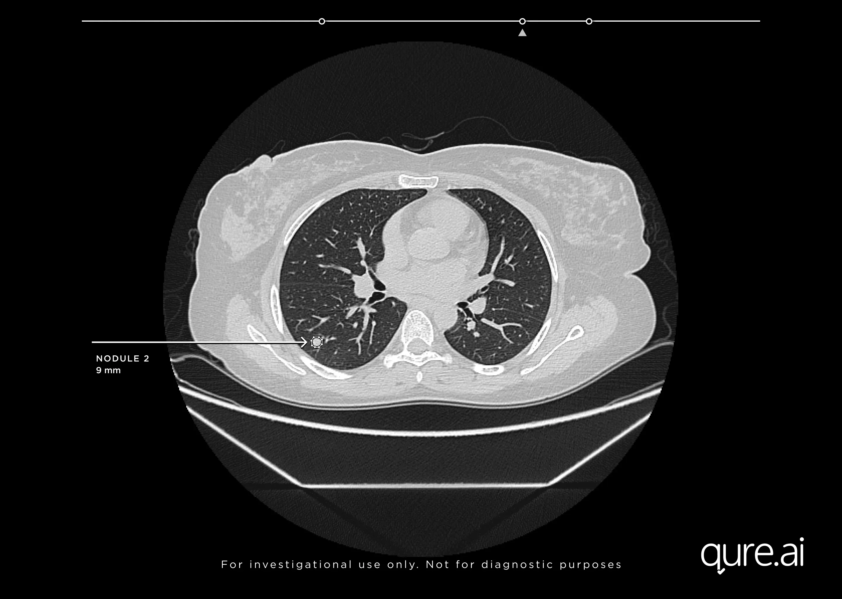 AI in Medical Imaging and Early Cancer Detection