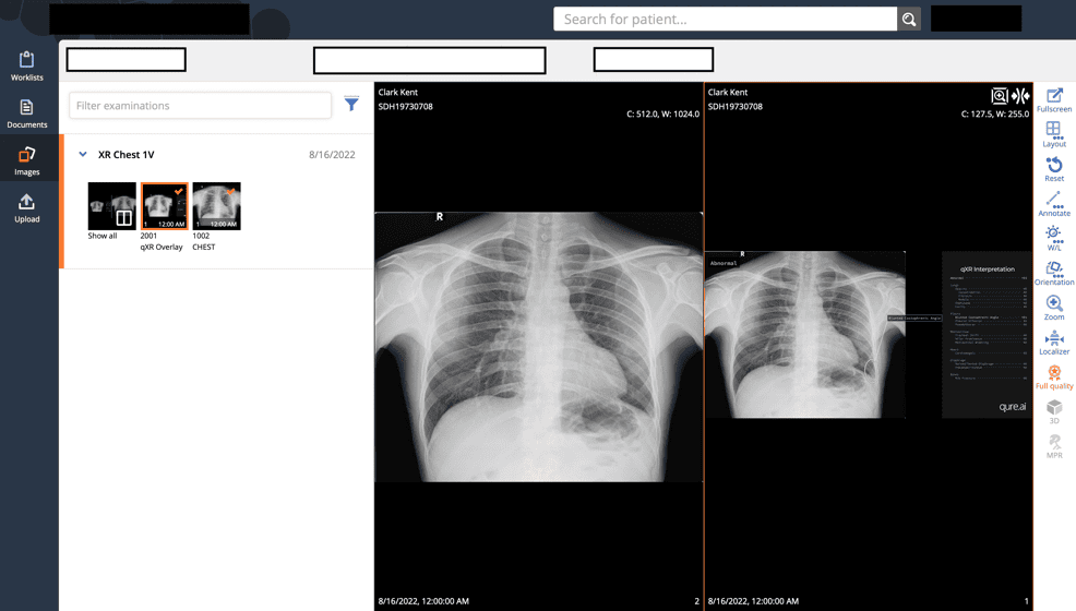 chest-x-ray-986x560.png