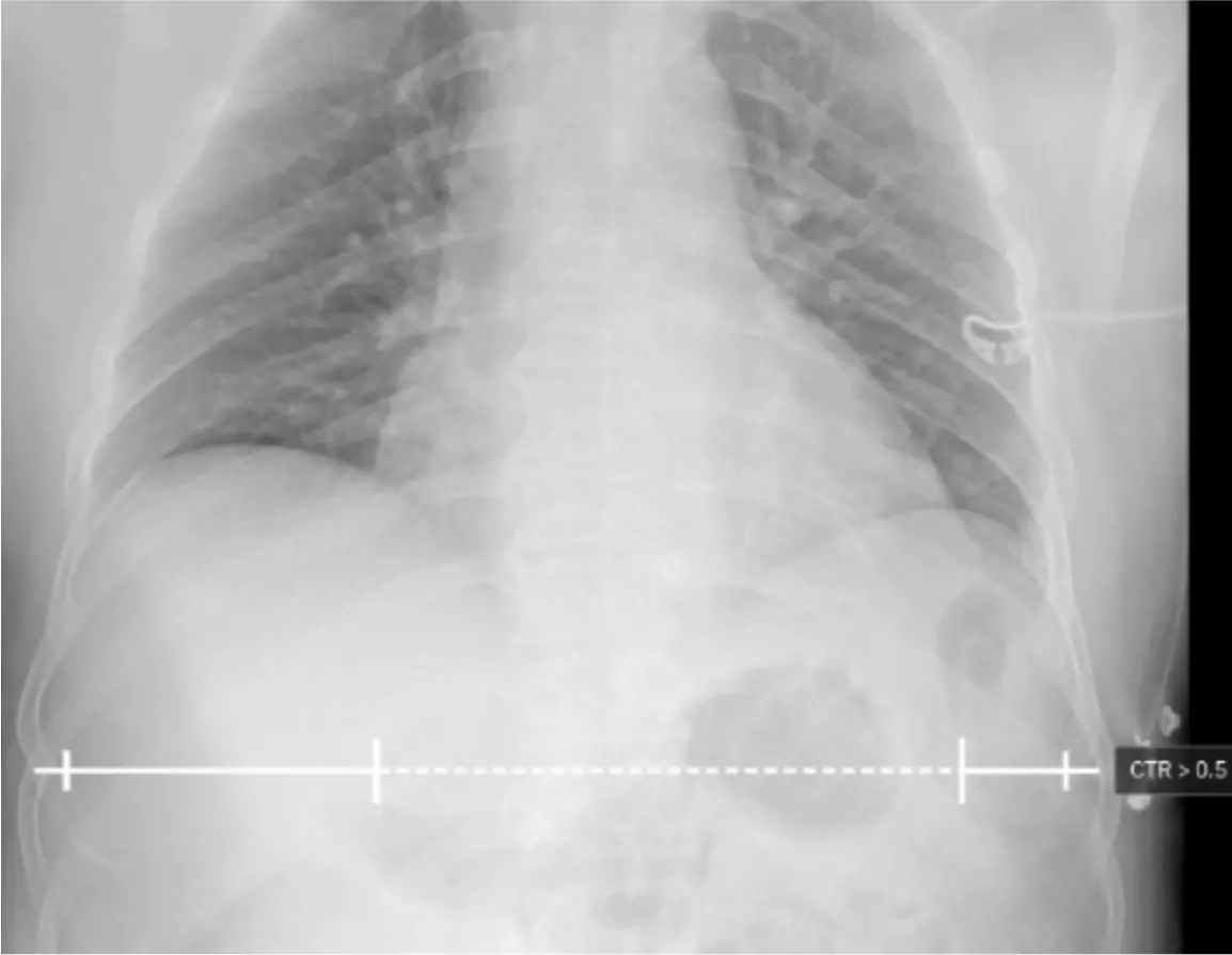 qXR AI enabled comprehensive Chest X-ray reporting tool